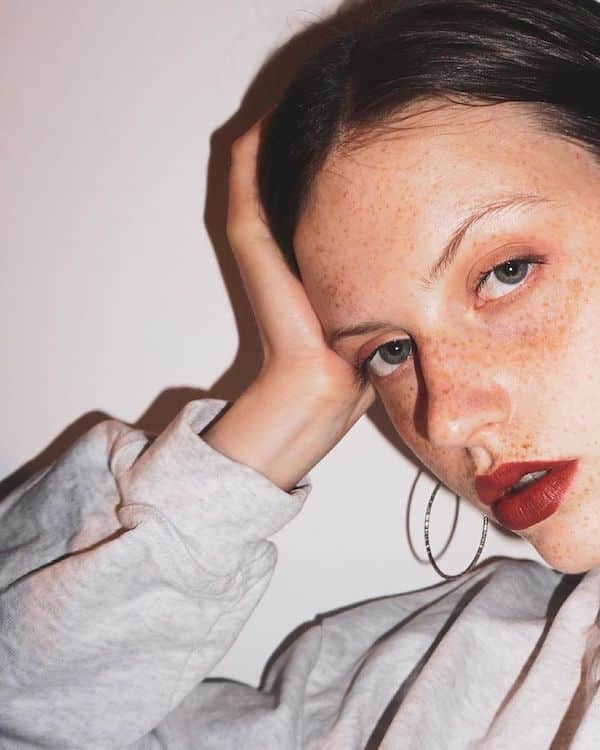 freckle2